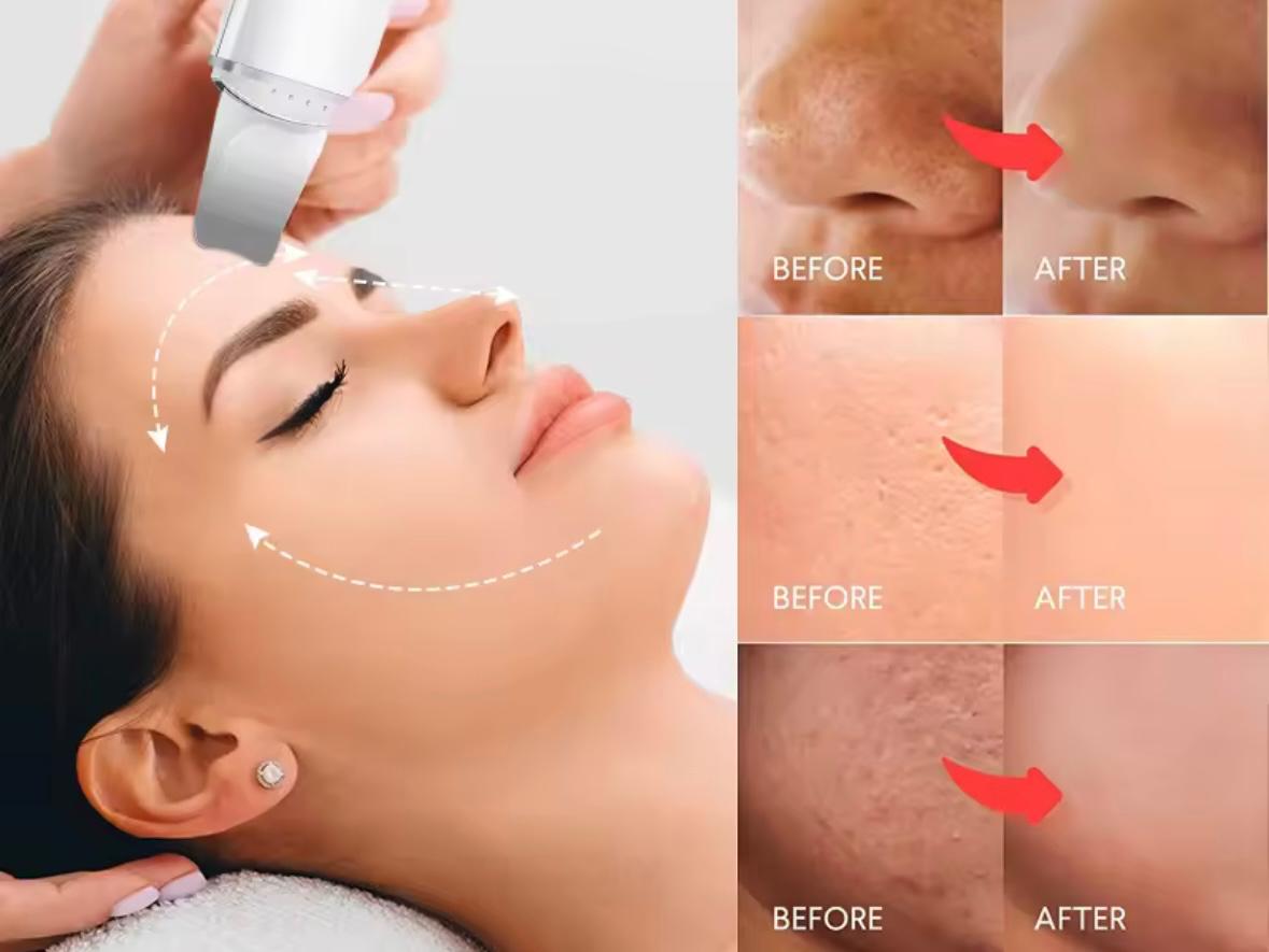 LumiSkin Peeling Ultrasónico Facial